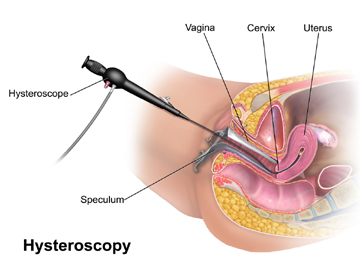 Best laparoscopic hysterectomy in Bhopal, MP by Dr Deepti Gupta